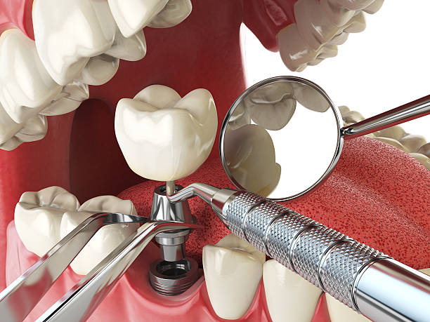 Best Emergency Root Canal Treatment in Ocala Estates, FL